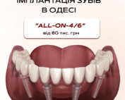 імплантація all-on-6 та all-on-4