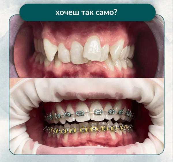 встановлення брекетів В Одесі